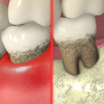 severe_periodontitis